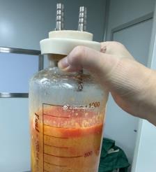苏州水动力吸脂手术要做多久？